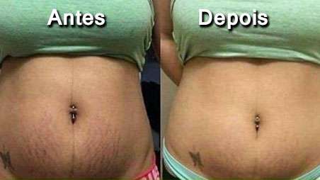 Cicatribem Creme Antiestrias!